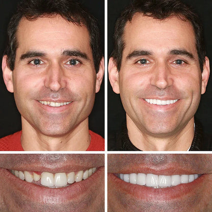 SmileLock – Premium Full Denture Solution
