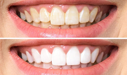 AuraBright – Advanced PAP+ Teeth Whitening Strips