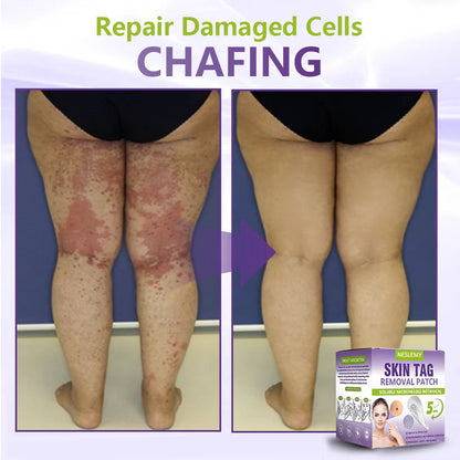 ClearDerma – Microneedle Skin Tag Removal Patch